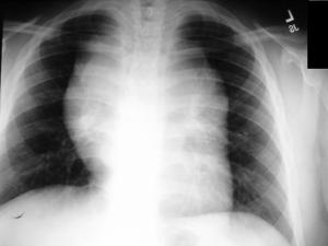 X-Rays can identify initially if a lymphoma Mass is in your chest